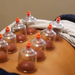 Healing Hands Sports Chiropractic Cupping Service Modality Photo for Website by Valiago 2024